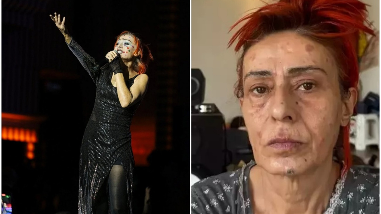 Yüzü yanan Yıldız Tilbe’den ilginç çözüm: Renkli boyalarla yanık izlerini kapattı