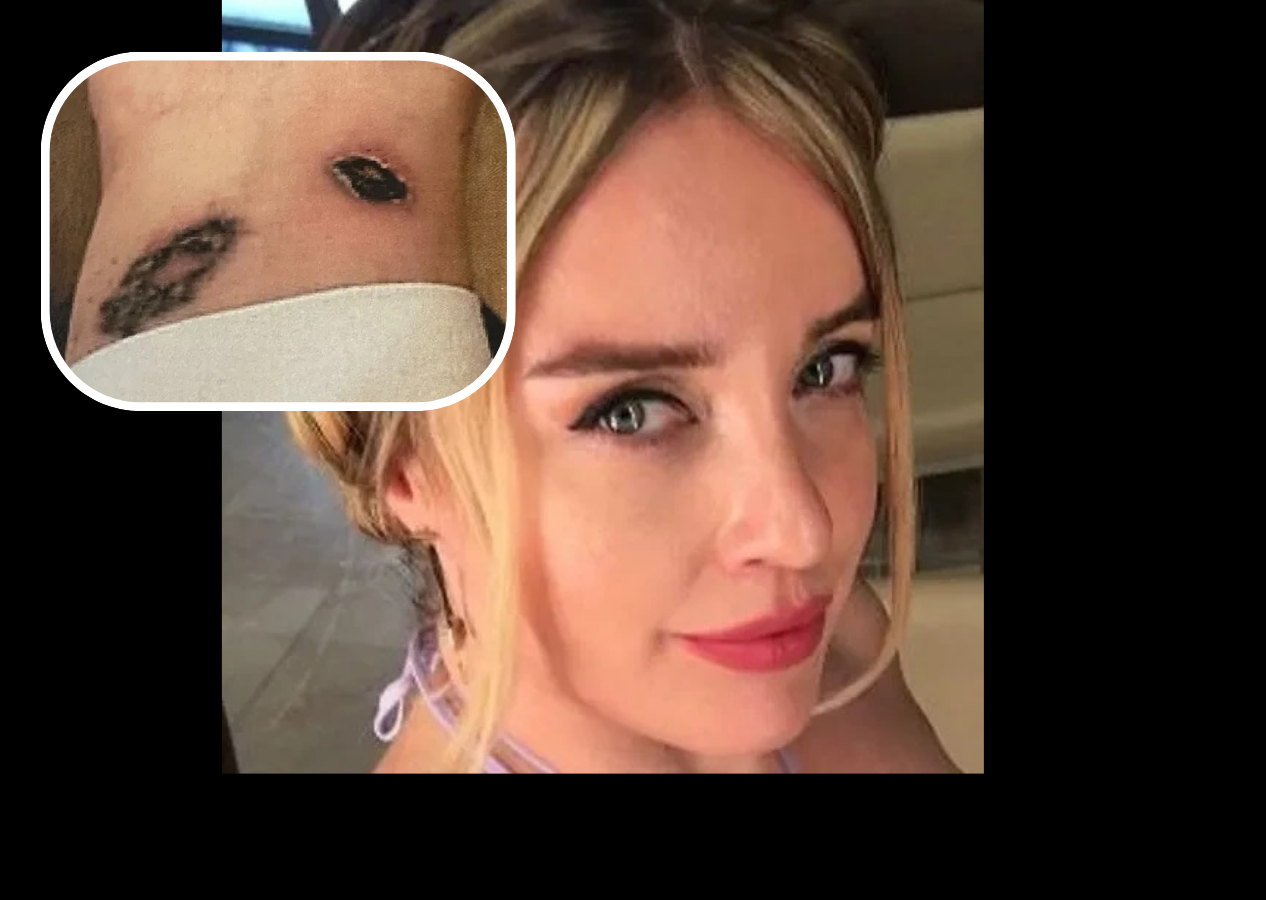 Dövmelerini sildirmek için gittiği klinikte kabusu yaşadı! Vücudunda yanıklar ve iltihaplanma oluştu: Neredeyse kolunu kaybedecekti