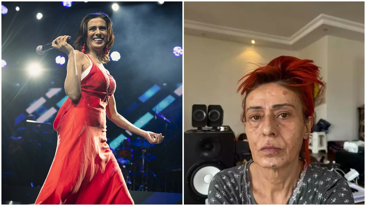 Yıldız Tilbe’nin yüzündeki kimyasal yanıkla ilgili yeni gelişme