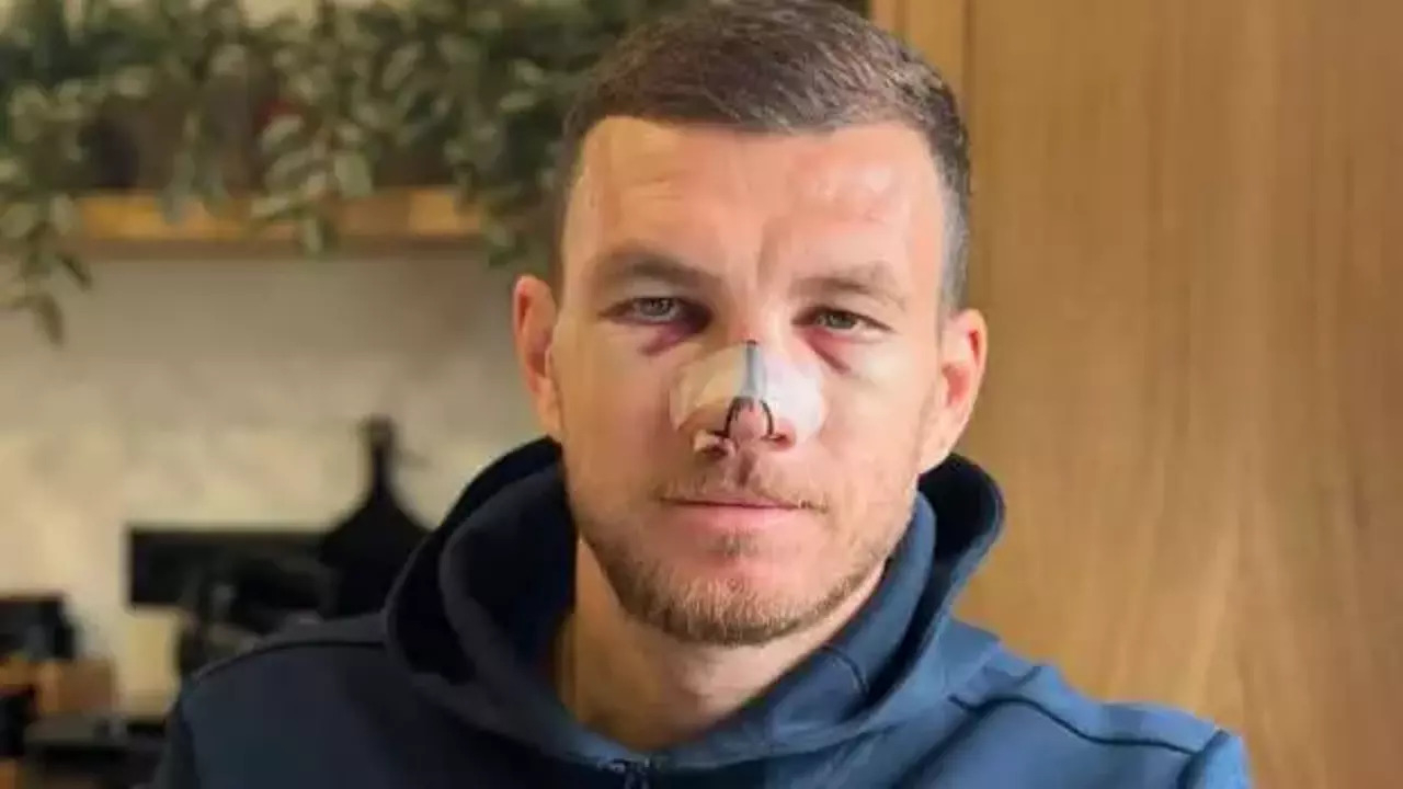 Milli maçta burnu kırılan Edin Dzeko ameliyat edilecek mi?