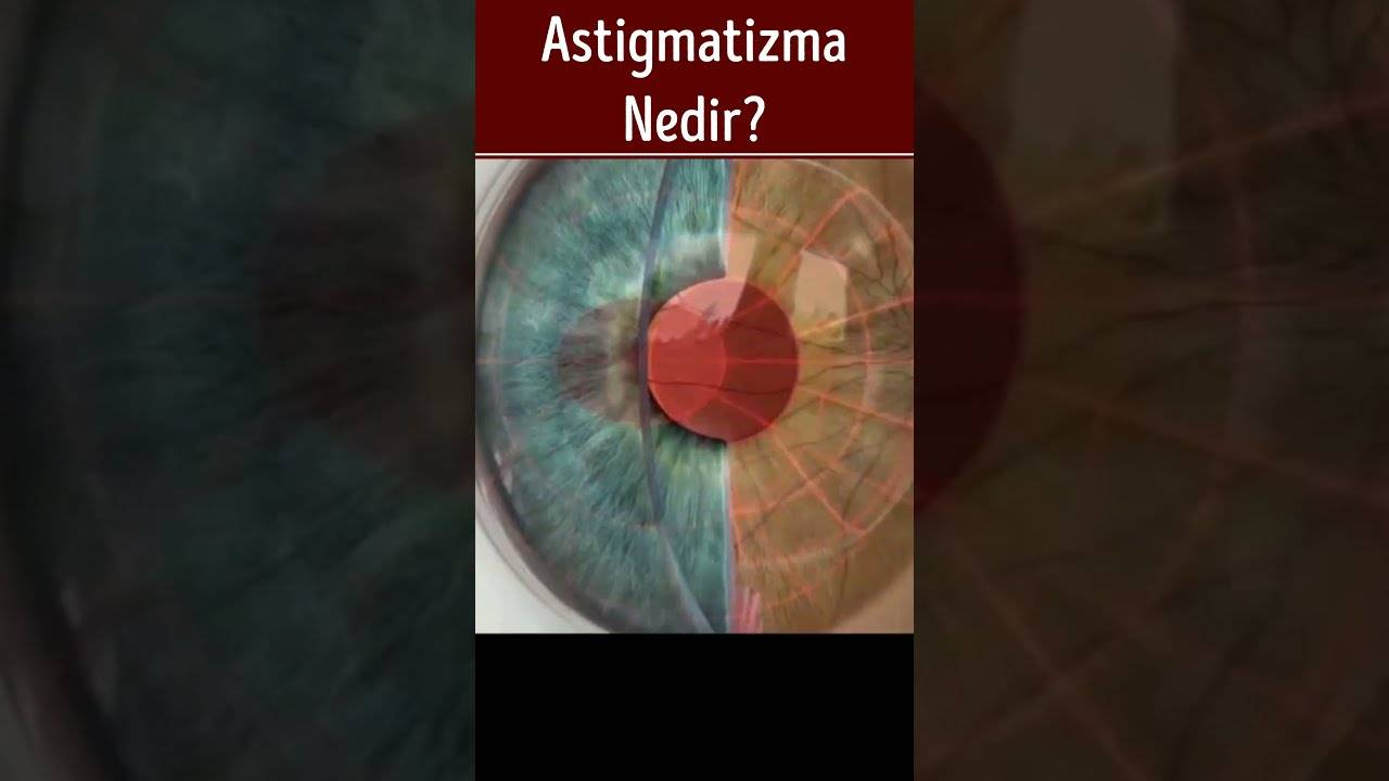 Astigmatı olanlar dikkat! Erken tedavi edilmeyen astigmatizma kalıcı görme kaybına yol açabiliyor