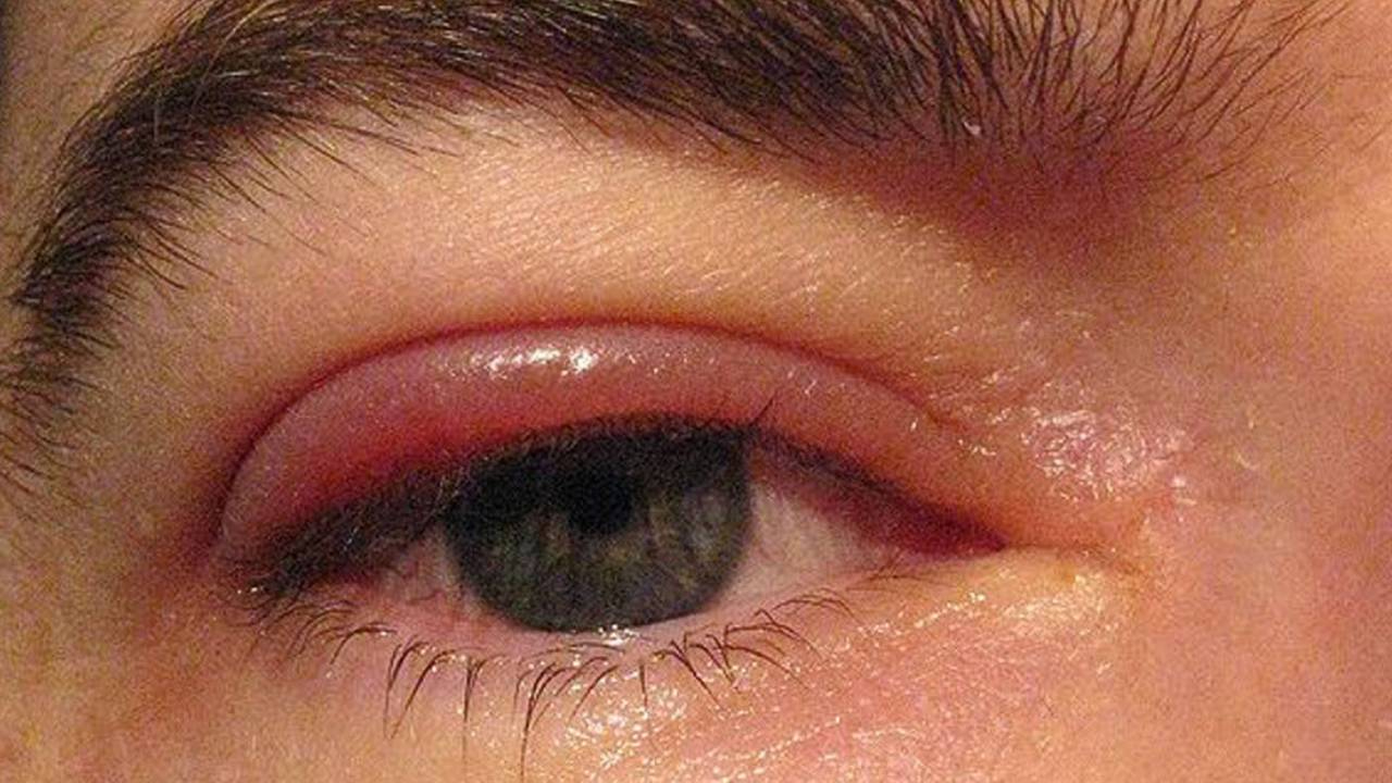 Blefaritin nedir? Göz kapaklarında kızarıklık ve şişlik olanlar dikkat