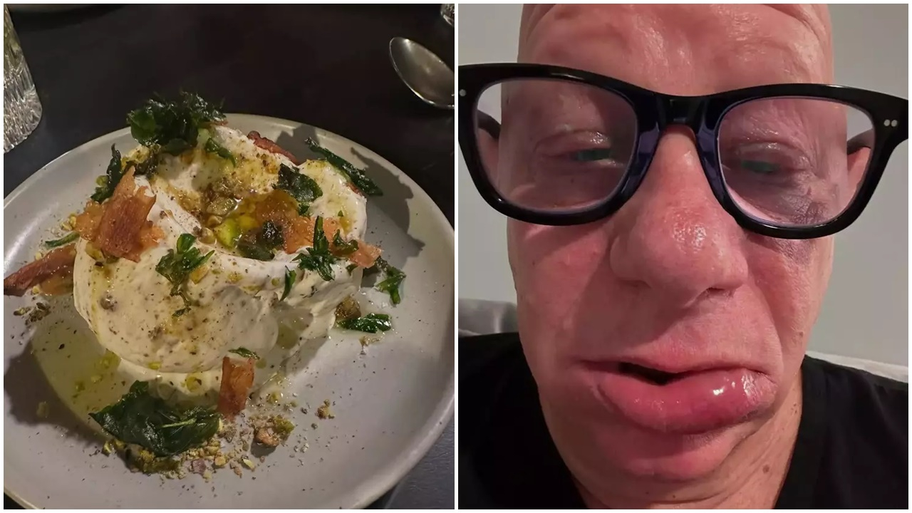 Yediği dondurma hastanelik etti! Komedyen Jeff Ross'un dudakları balon gibi şişti