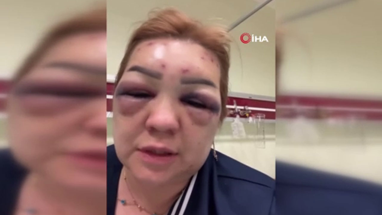 Botoks rüyası kabusa döndü! Güzelleşeceğim diye tanınmaz hale geldi!
