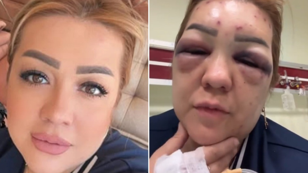 Kahramanmaraş’ta botoks faciası: Kuaför Sibel Çınar hastanelik oldu