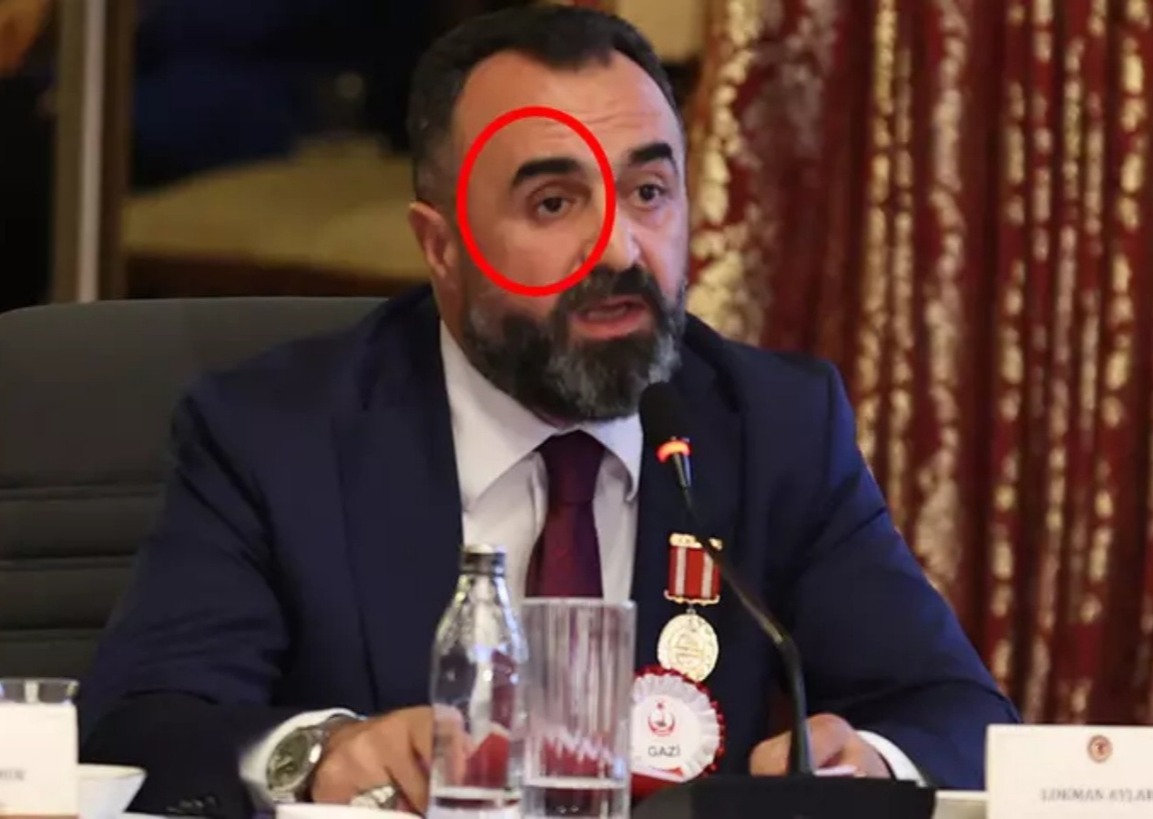 TBMM komisyonunda tarihi an! Lokman Aylar protez gözünü çıkarıp konuştu: Teröre bedel ödedim!