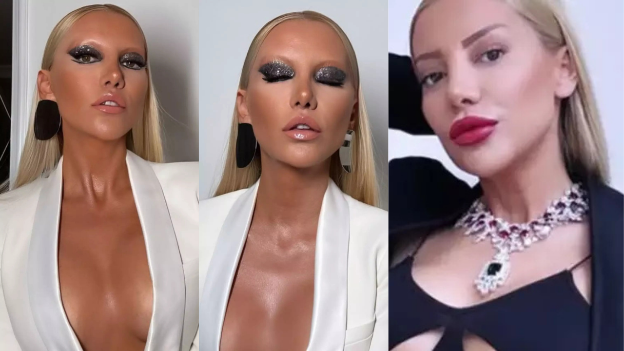 Gülşah Saraçoğlu'nun 9 saatlik estetik operasyonu gündem oldu: Tanınmaz hale geldi! 'Resmen yüz nakli'