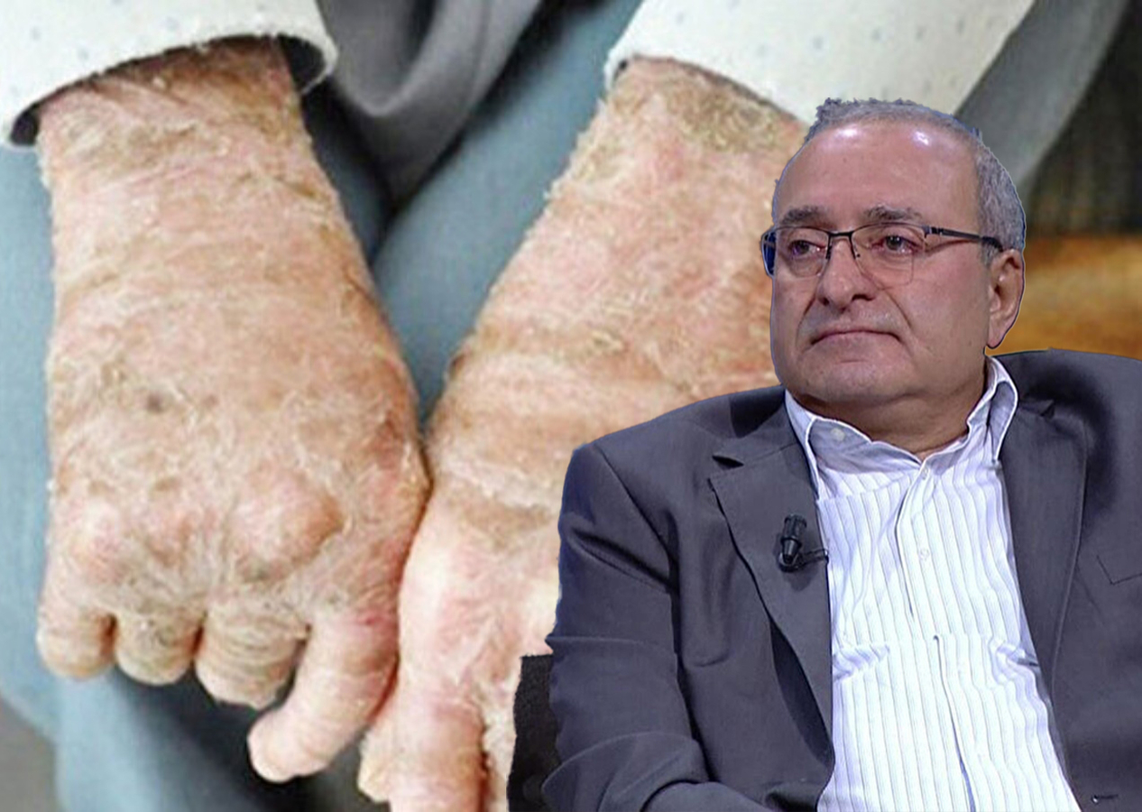 Petroleum Jelly, Kara Batak Kuşu: Bir Kronik Cilt Hastasının Sırları