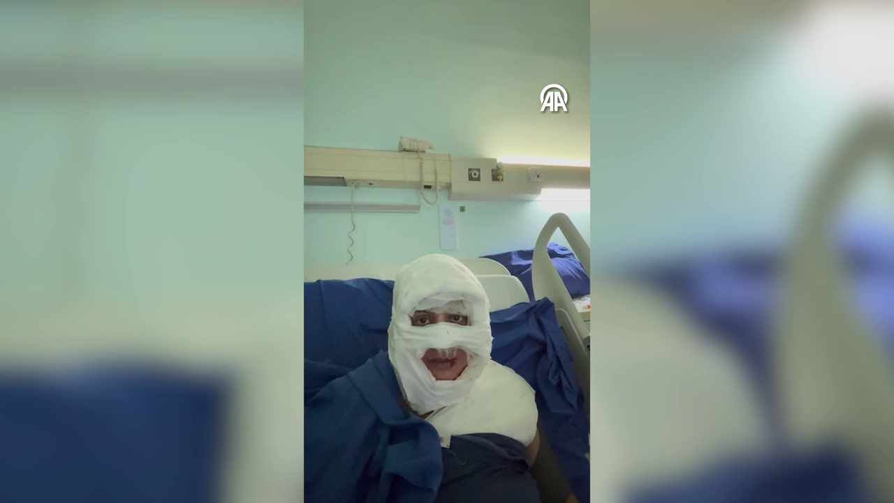 Kadıköy’de dehşeti yaşadı! Genç kadına saldıran cani yüzüne kolonya döküp ateşe verdi