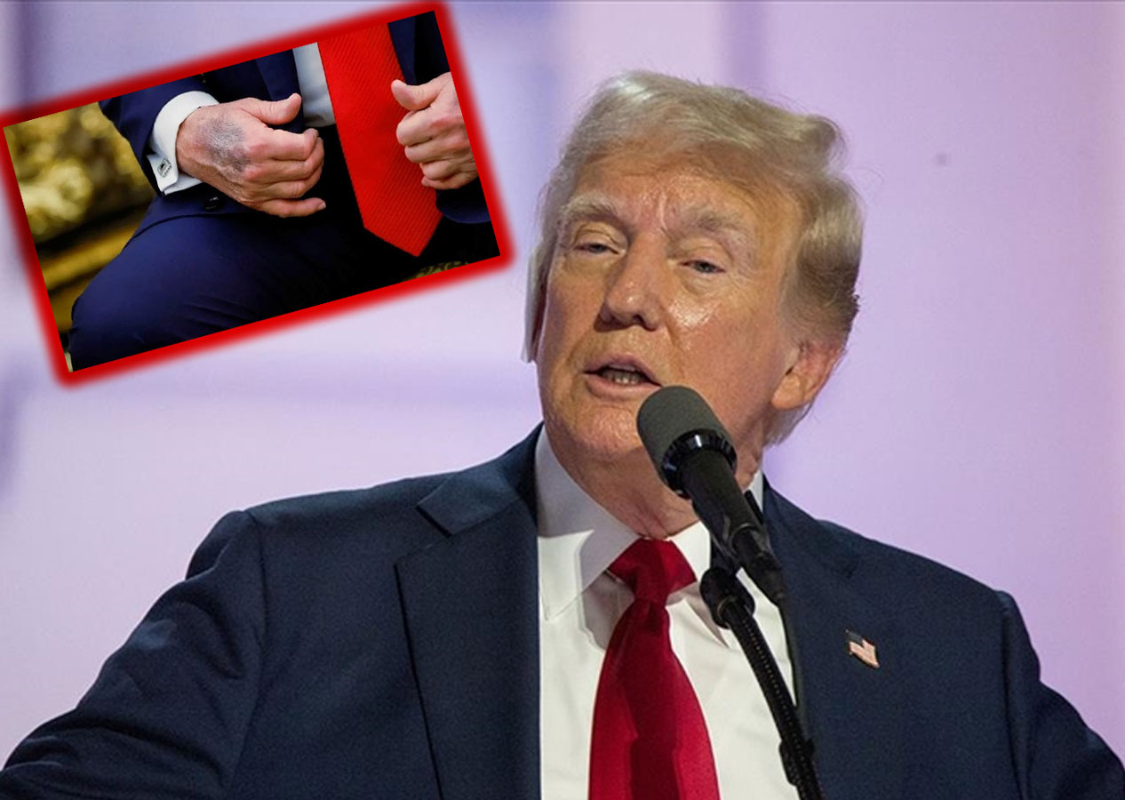 Merak konusu olmuştu! Trump elindeki morluklarının sebebini açıkladı
