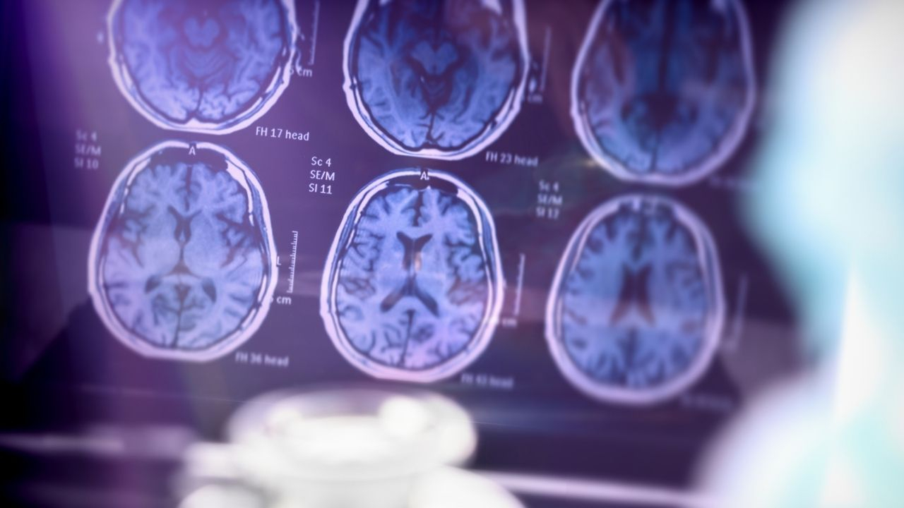 Alzheimer’a karşı bilim dünyasından iki güçlü adım: Nergis ve yeni bir dil