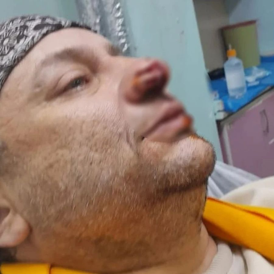 Başıboş pitbull saldırısı! Sanatçının burnunu ısırdı, et yiyen bakteri hastalığı ortaya çıktı: Entübe edildi...