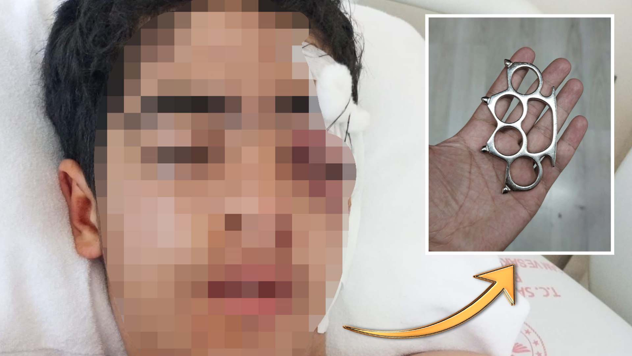 "Bana şaka yapma" diyen çocuğa muştalı saldırı! Akran zorbalığı yüzünden gözünü kaybedebilir!