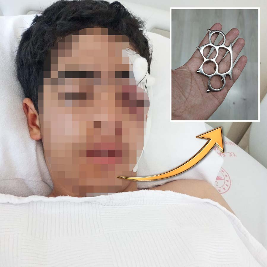 "Bana şaka yapma" diyen çocuğa muştalı saldırı! Akran zorbalığı yüzünden gözünü kaybedebilir!