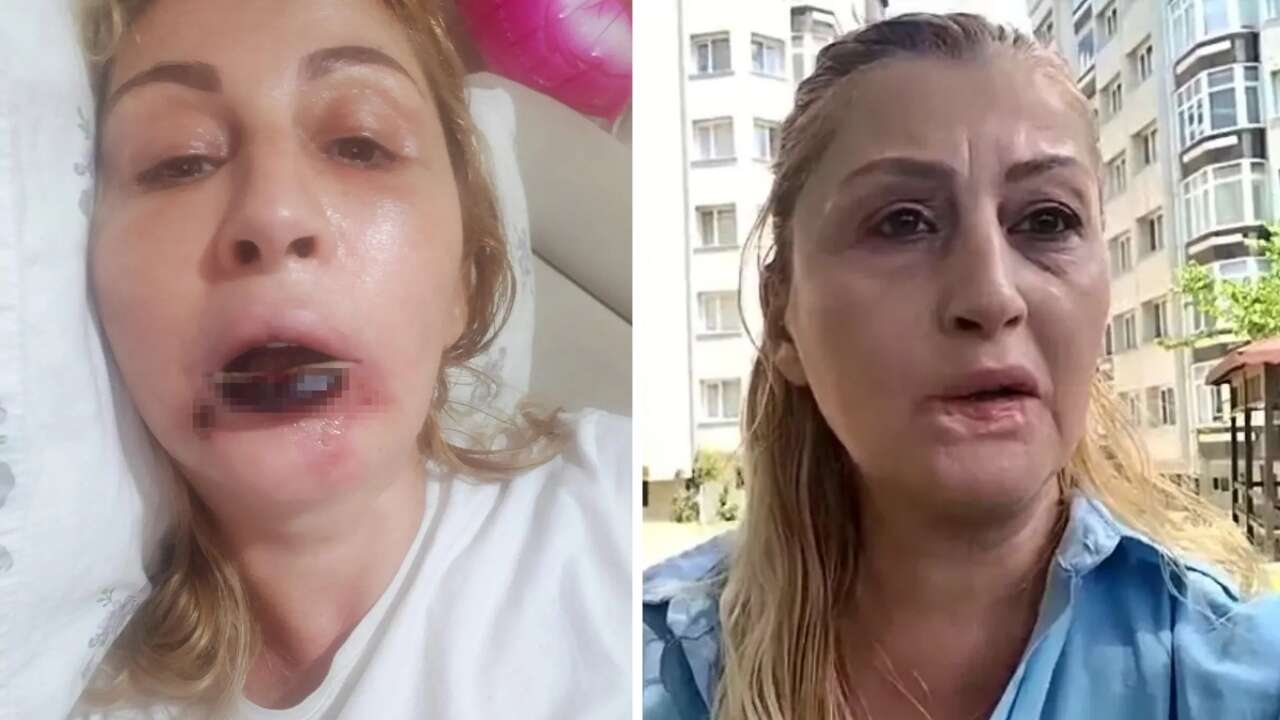 Güzellik merkezlerine güvenenler dikkat! Dudağı çürüdü: 7 yıllık estetik kabusunda skandal karar!