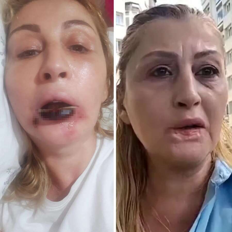 Güzellik merkezlerine güvenenler dikkat! Dudağı çürüdü: 7 yıllık estetik kabusunda skandal karar!