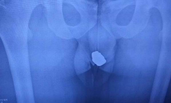 Bu röntgen fotoğrafında 3 yüzük, 4 küpe,  2 kolye var!
