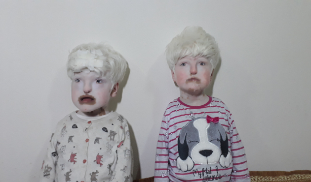 Albino kardeşlerin çifte dramı!