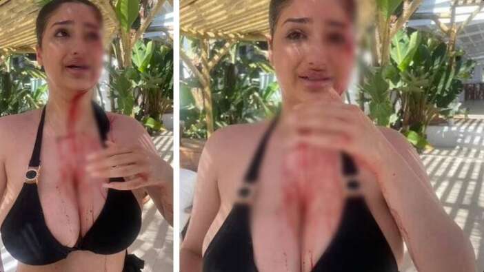 Şezlong kavgası kanlı bitti: Öğrencinin kafasında alkol şişesi fırlatıldı!