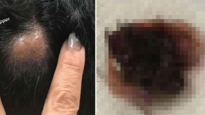 20 yıl boyunca böyle yaşamış! Ameliyat sonrası kafasından çıkanları gören doktor şoke oldu!