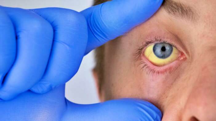 Şimdi de Meksika'da görüldü: Gizemli hepatit 20 ülkeye yayıldı!