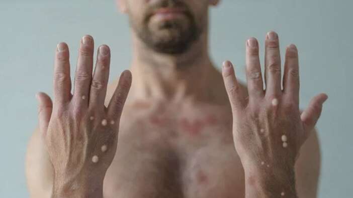 Böylesi görülmedi: Aynı gün koronavirüs, maymun çiçeği ve HIV testleri pozitif çıktı
