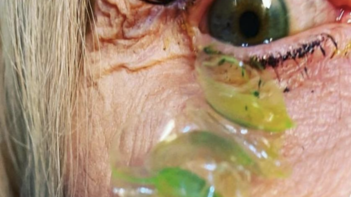 Gözünde 23 tane kontakt lens unutan hastanın videosu viral oldu
