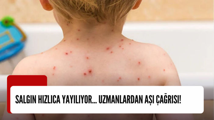 Salgın hızlıca yayılıyor... Uzmanlardan aşı çağrısı!