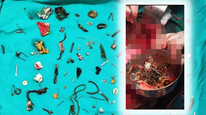 Mide ağrısıyla hastaneye gitti: Bağırsaklarından 60 ev eşyası çıktı