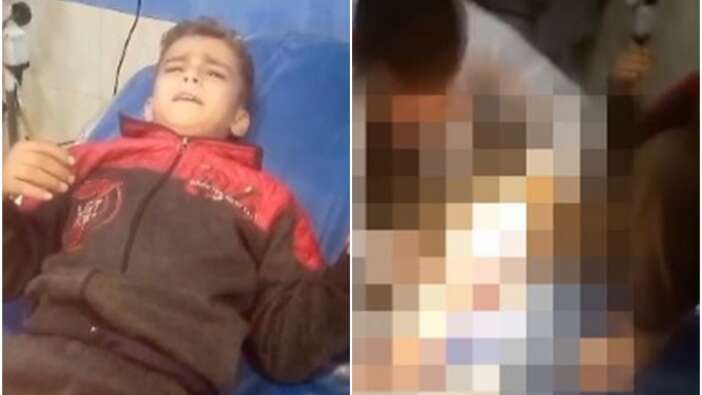 İsrail'in zulmü bitmiyor! Saldırılarda yaralanan Gazze'li çocuk anestezisiz ameliyat olmanın acısına dayanabilmek için bakın ne yaptı