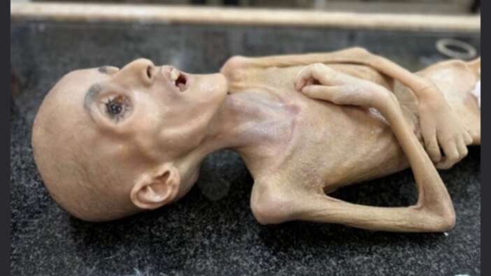 Gazze'de trajedinin fotoğrafı... Filistinli Yezen el-Kefarne yetersiz beslenme nedeniyle hayatını kaybetti