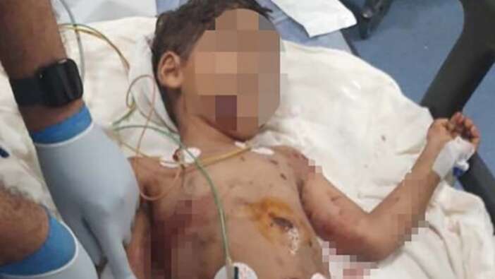 Adana'da 5 köpeğin saldırısına uğrayan minik Abbas hastanede yaşam mücadelesi veriyor