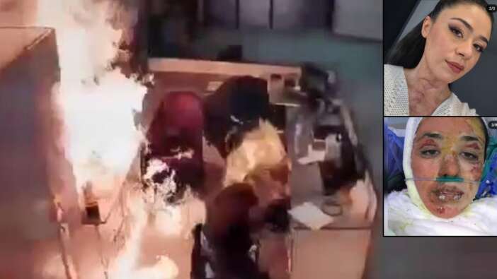 Erkek hemşirenin "Yakayım mı sizi" şakası faciaya dönüştü, meslektaşlarını hastanelik etti