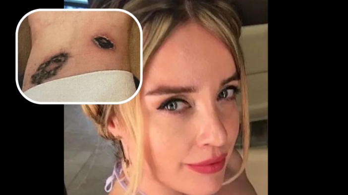Dövmelerini sildirmek için gittiği klinikte kabusu yaşadı! Vücudunda yanıklar ve iltihaplanma oluştu: Neredeyse kolunu kaybedecekti