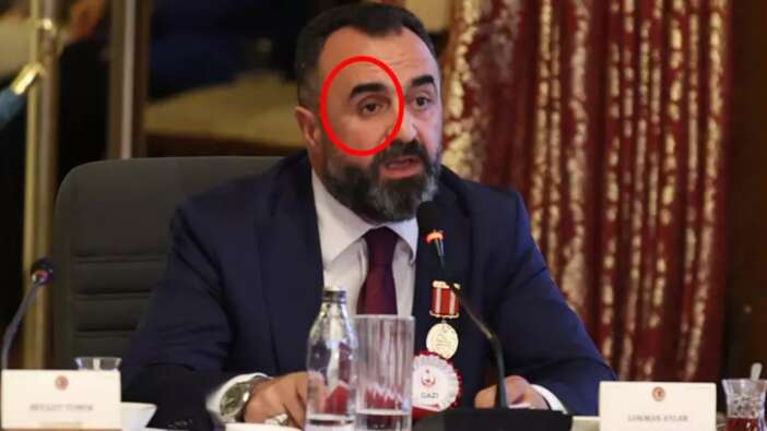 TBMM komisyonunda tarihi an! Lokman Aylar protez gözünü çıkarıp konuştu: Teröre bedel ödedim!