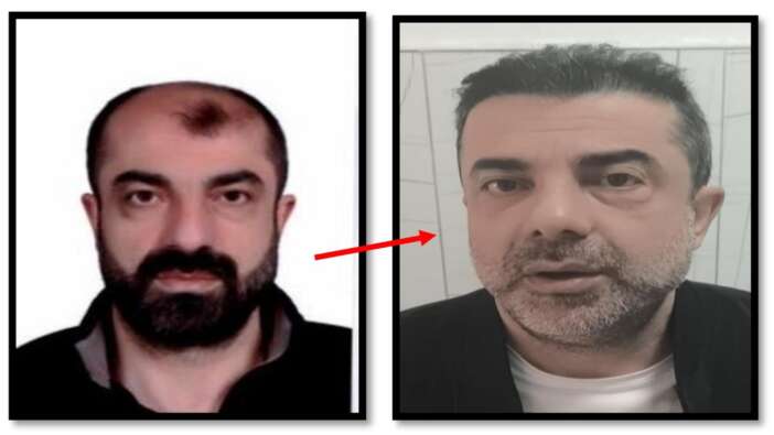 BİR GARİP OLAY! Ankara'da cinayet azmettiricisi, ameliyatla yüzünü değiştirdi! Yine de polisten kaçamadı...