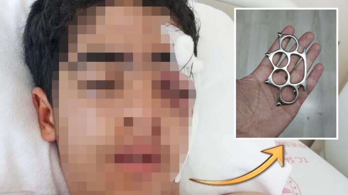 "Bana şaka yapma" diyen çocuğa muştalı saldırı! Akran zorbalığı yüzünden gözünü kaybedebilir!